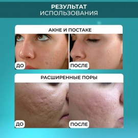 Мезороллер для лица и тела 5 в 1 Derma Roller (дермароллер)