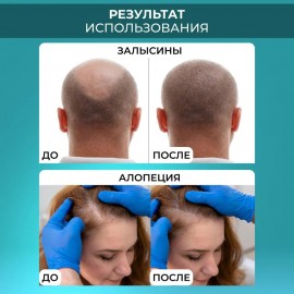 Мезороллер для лица и тела 5 в 1 Derma Roller (дермароллер)