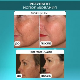 Мезороллер для лица и тела 5 в 1 Derma Roller (дермароллер)